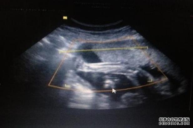 甘肃代孕母 2022年甘肃试管婴儿哪家医院好? ‘五周彩超17*11*18是男是女’