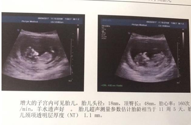 山西试管婴儿流程时间,山西红房子试管婴儿建档流程