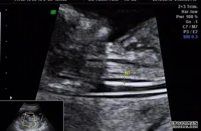 脑干胶质瘤早期症状解析,这些都可能是脑干胶质瘤的信号