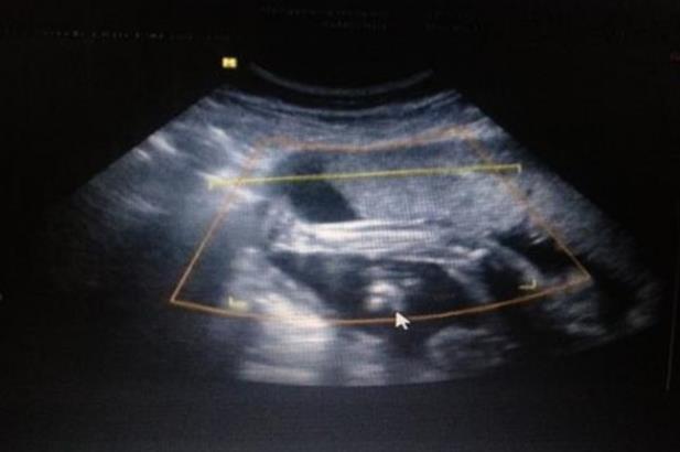 试管婴儿为什么在肚子上打针？怎么给自己打针？