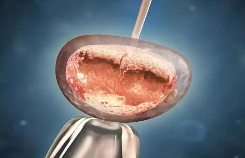 泰国试管婴儿真实经历试管婴儿要注重哪些环节？