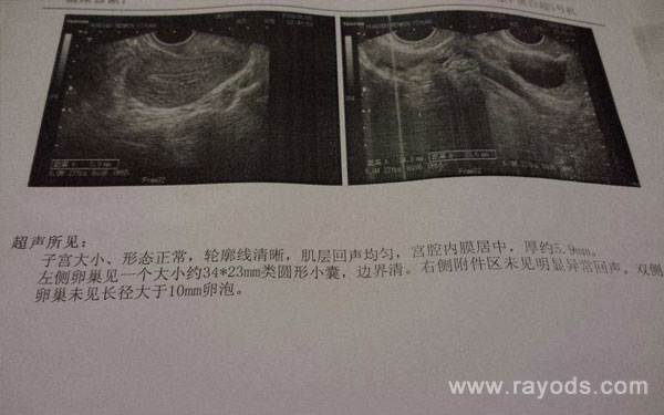 卵泡萎缩B超单